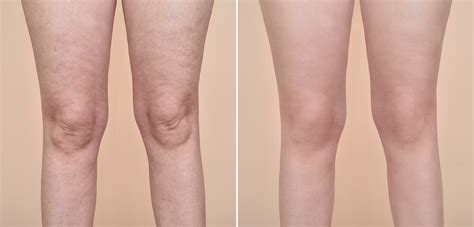 endermologie before and after.
